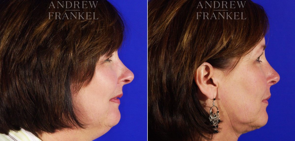 Jawline Contouring before and after photos in Beverly Hills, CA, Patient 3979