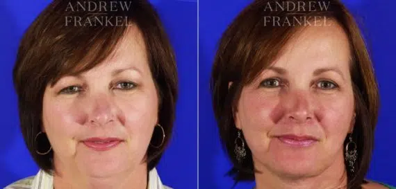 Jawline Contouring before and after photos in Beverly Hills, CA, Patient 3979