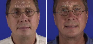 Jawline Contouring before and after photos in Beverly Hills, CA, Patient 4010
