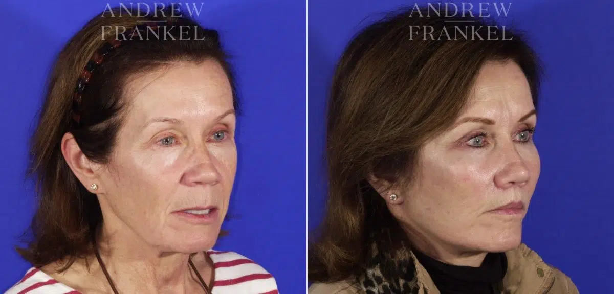 Midface Lift before and after photos in Beverly Hills, CA, Patient 4023