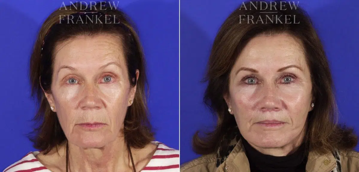 Midface Lift before and after photos in Beverly Hills, CA, Patient 4023