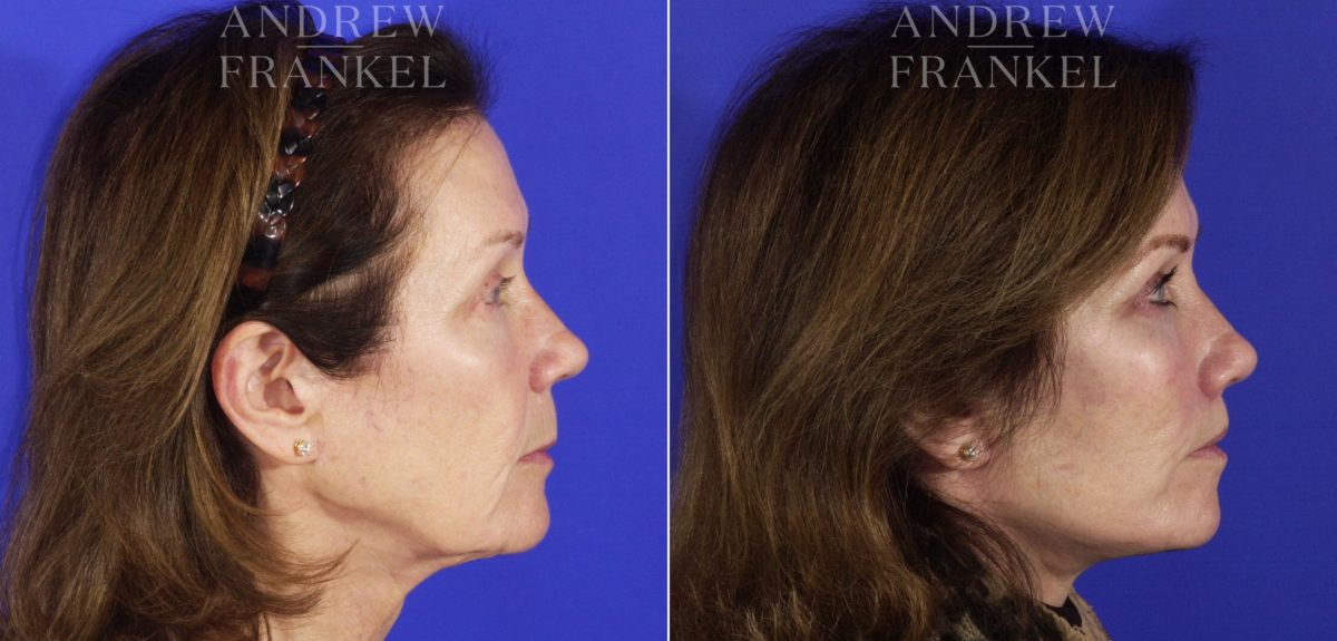 Midface Lift before and after photos in Beverly Hills, CA, Patient 4023