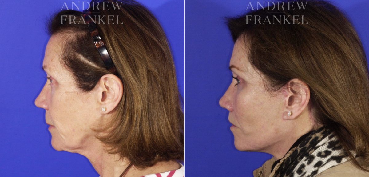 Midface Lift before and after photos in Beverly Hills, CA, Patient 4023