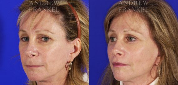 Midface Lift before and after photos in Beverly Hills, CA, Patient 4044