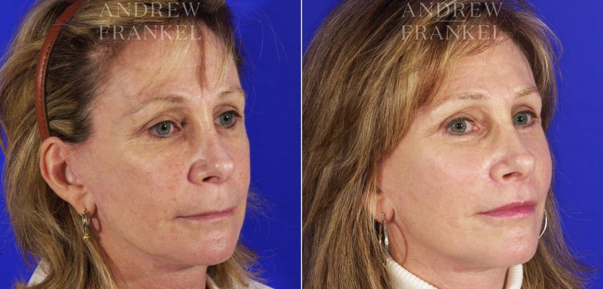 Midface Lift before and after photos in Beverly Hills, CA, Patient 4044