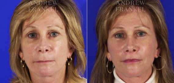 Midface Lift before and after photos in Beverly Hills, CA, Patient 4044