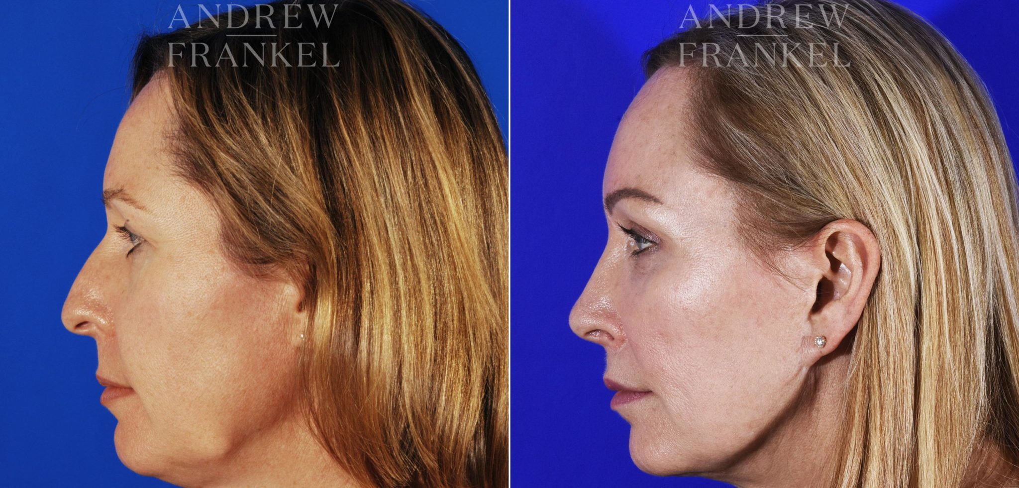 Midface Lift photos Beverly Hills, CA. Patient 4057