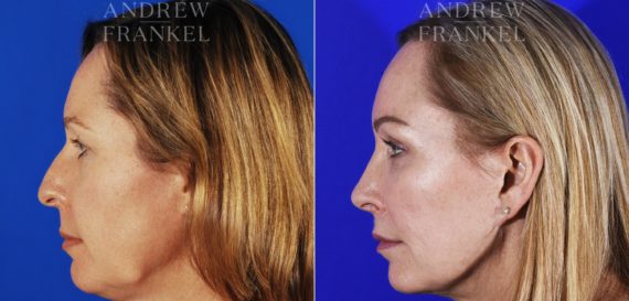 Midface Lift before and after photos in Beverly Hills, CA, Patient 4057