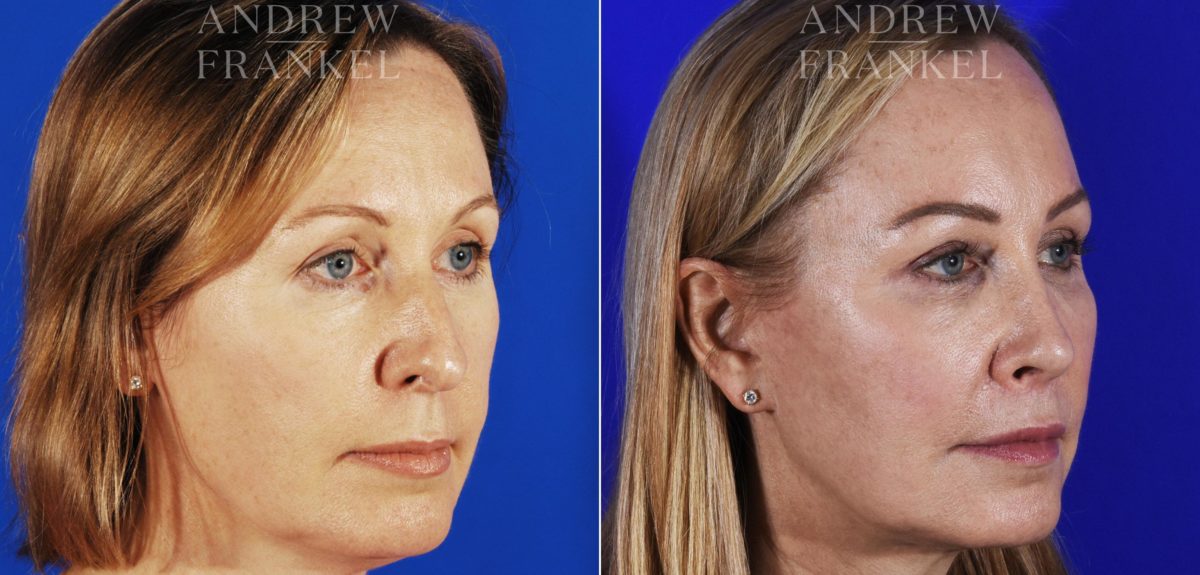 Midface Lift before and after photos in Beverly Hills, CA, Patient 4057