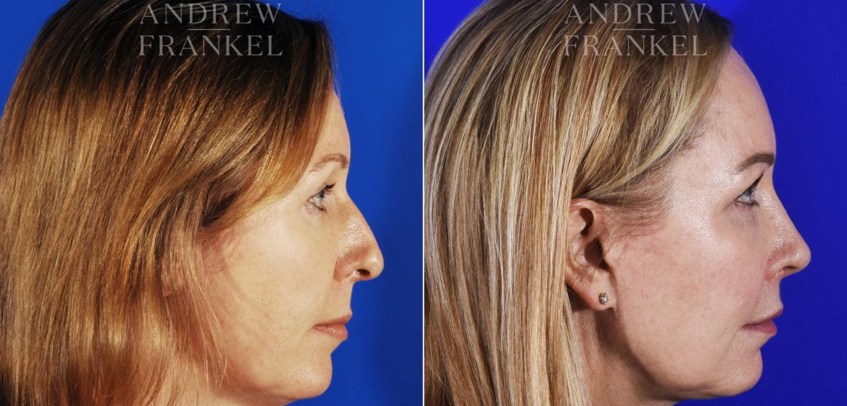 Midface Lift before and after photos in Beverly Hills, CA, Patient 4057