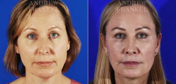 Midface Lift before and after photos in Beverly Hills, CA, Patient 4057