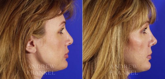 Revision Rhinoplasty before and after photos in Beverly Hills, CA, Patient 4058
