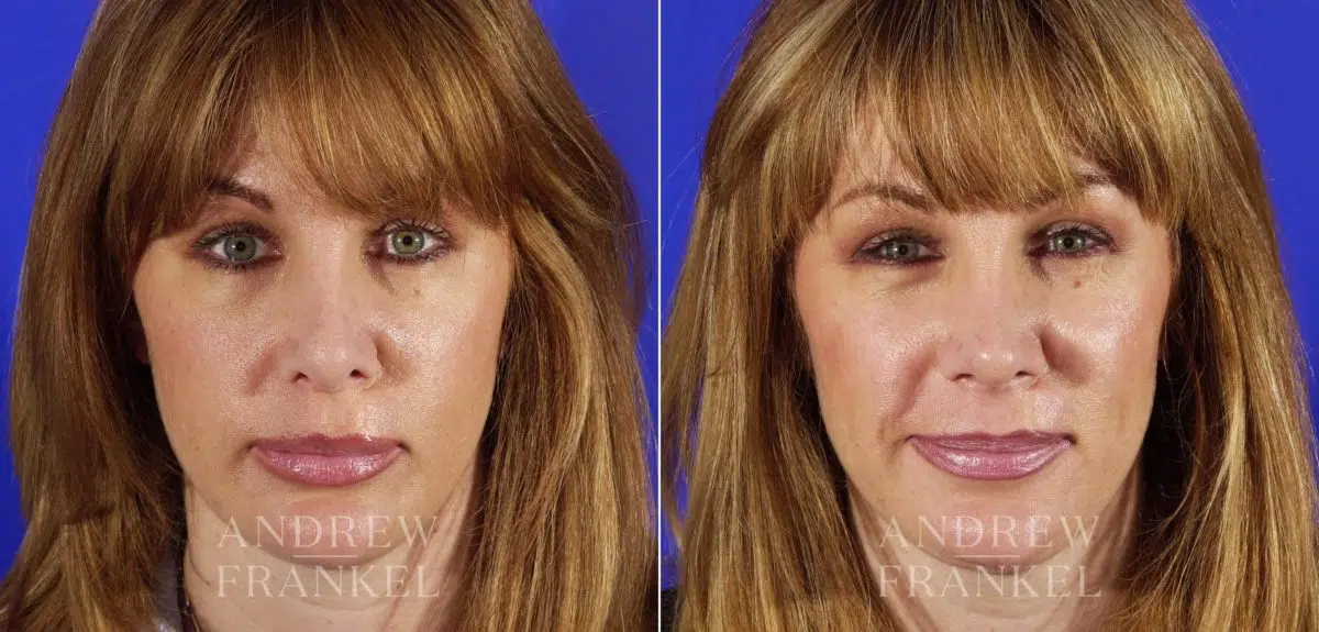 Revision Rhinoplasty before and after photos in Beverly Hills, CA, Patient 4058