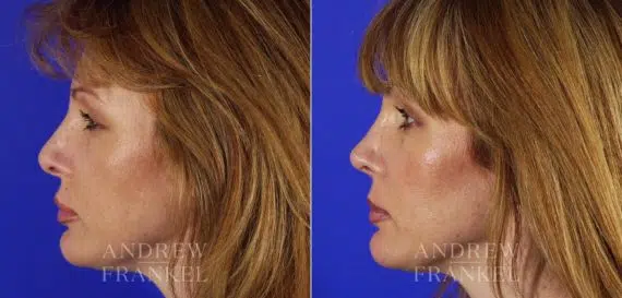 Revision Rhinoplasty before and after photos in Beverly Hills, CA, Patient 4058