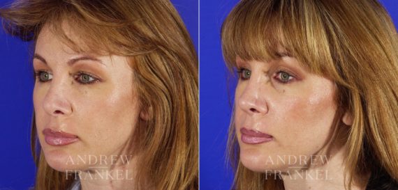 Revision Rhinoplasty before and after photos in Beverly Hills, CA, Patient 4058