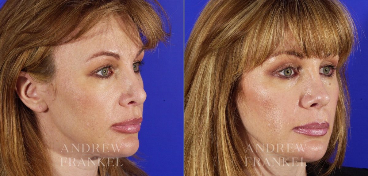 Revision Rhinoplasty before and after photos in Beverly Hills, CA, Patient 4058