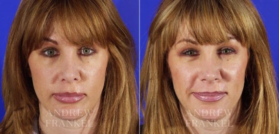 Revision Rhinoplasty before and after photos in Beverly Hills, CA, Patient 4058