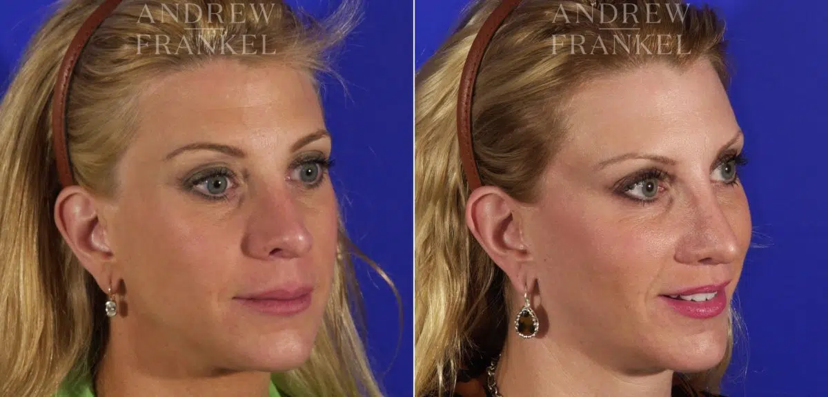 Midface Lift before and after photos in Beverly Hills, CA, Patient 4392