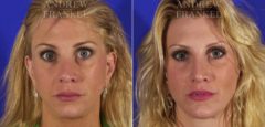 Midface Lift before and after photos in Beverly Hills, CA, Patient 4392