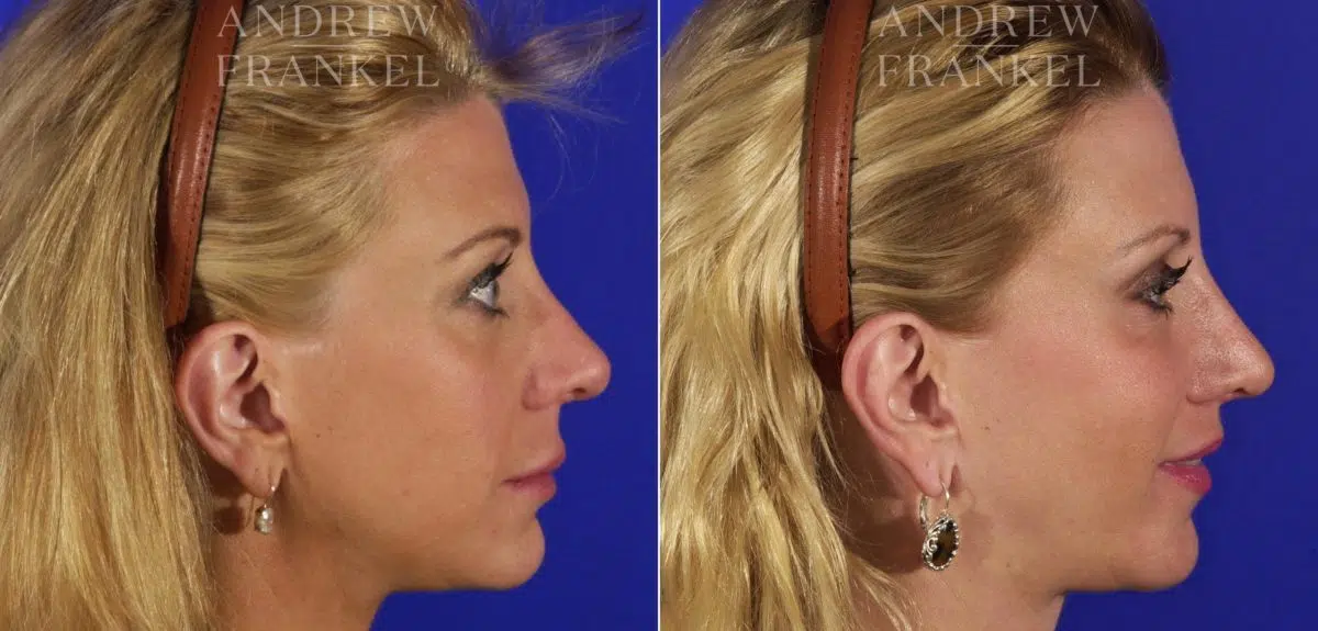Midface Lift before and after photos in Beverly Hills, CA, Patient 4392