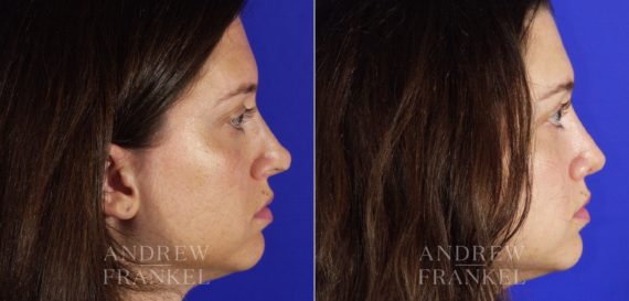 Revision Rhinoplasty before and after photos in Beverly Hills, CA, Patient 4410