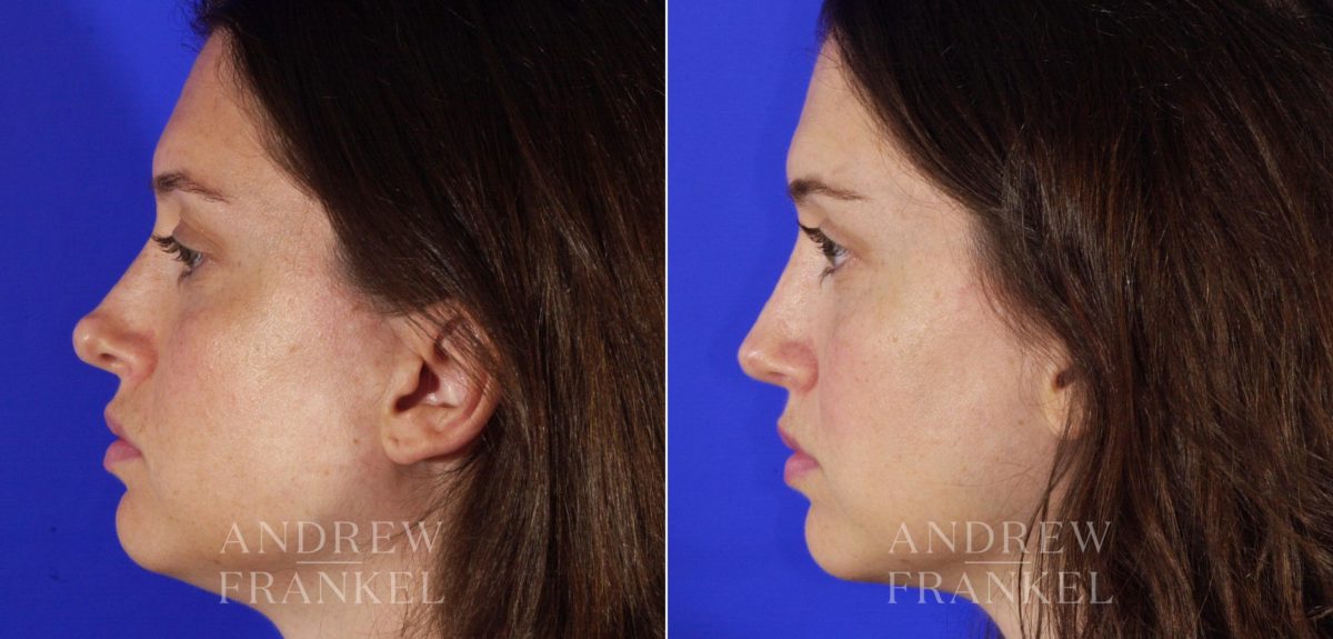 Revision Rhinoplasty before and after photos in Beverly Hills, CA, Patient 4410