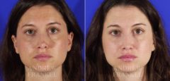 Revision Rhinoplasty before and after photos in Beverly Hills, CA, Patient 4410