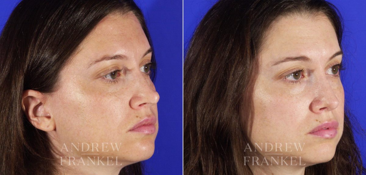 Revision Rhinoplasty before and after photos in Beverly Hills, CA, Patient 4410