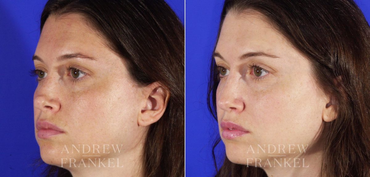 Revision Rhinoplasty before and after photos in Beverly Hills, CA, Patient 4410