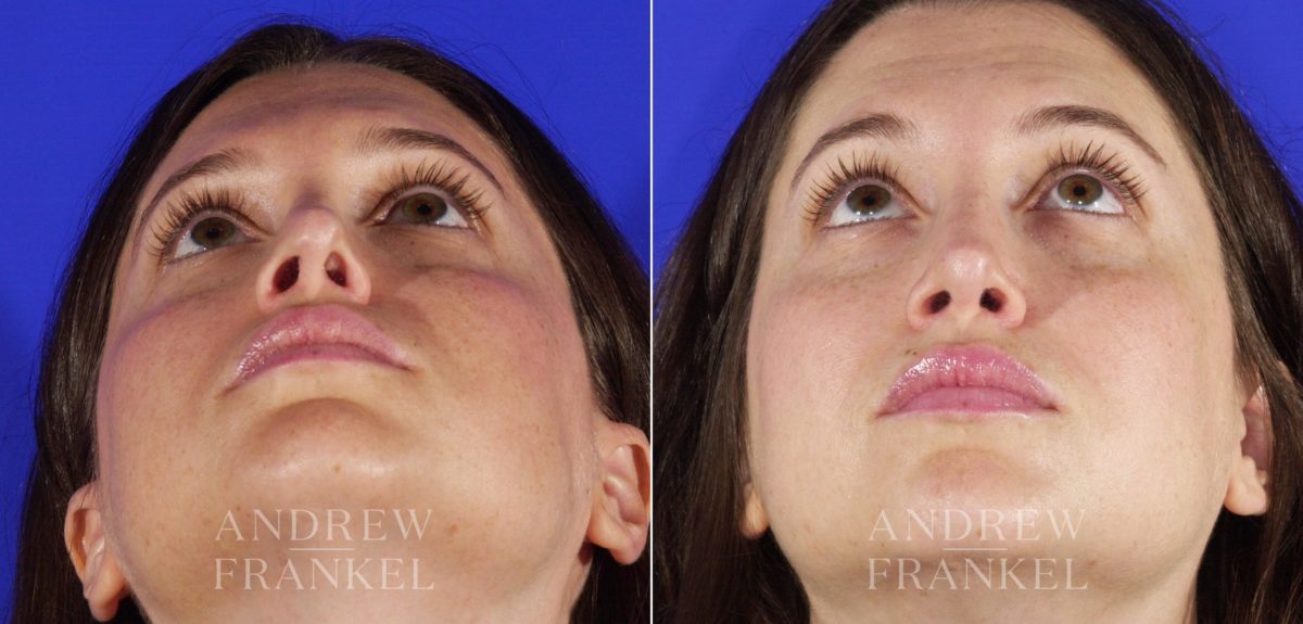 Revision Rhinoplasty before and after photos in Beverly Hills, CA, Patient 4410
