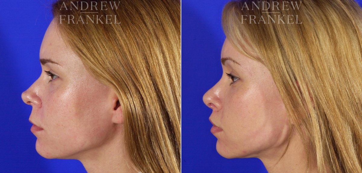 Lip Lift before and after photos in Beverly Hills, CA, Patient 4431