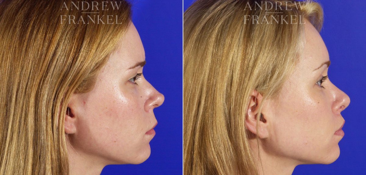 Lip Lift before and after photos in Beverly Hills, CA, Patient 4431