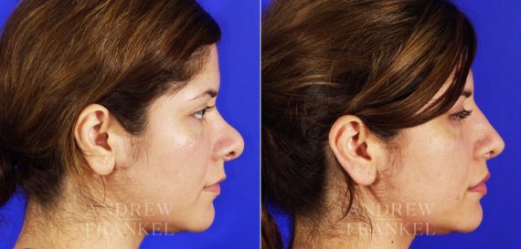 Revision Rhinoplasty before and after photos in Beverly Hills, CA, Patient 4454