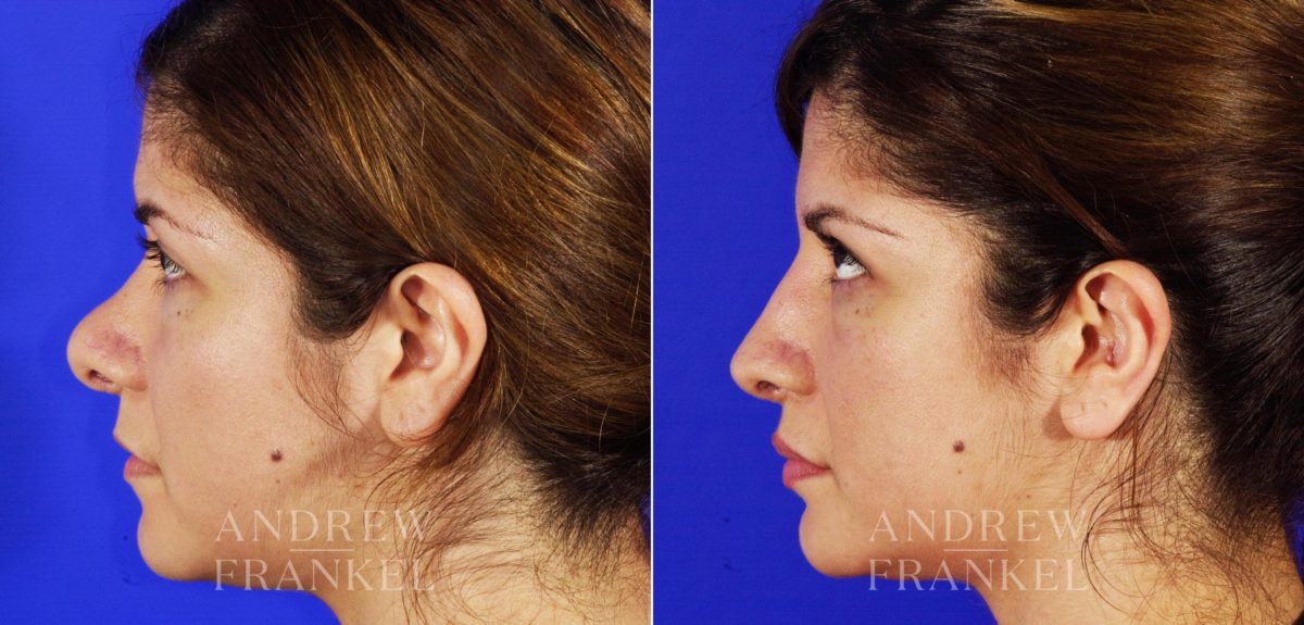 Revision Rhinoplasty before and after photos in Beverly Hills, CA, Patient 4454