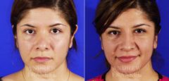 Revision Rhinoplasty before and after photos in Beverly Hills, CA, Patient 4454