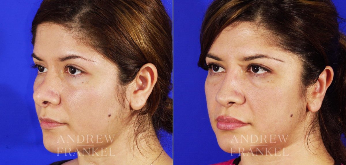 Revision Rhinoplasty before and after photos in Beverly Hills, CA, Patient 4454