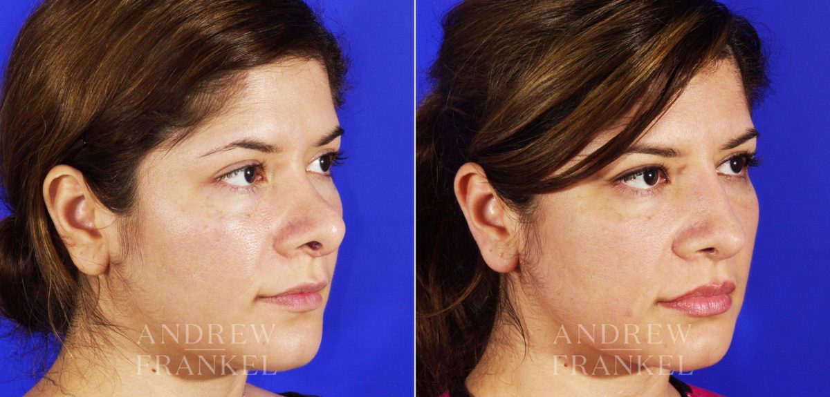 Revision Rhinoplasty before and after photos in Beverly Hills, CA, Patient 4454