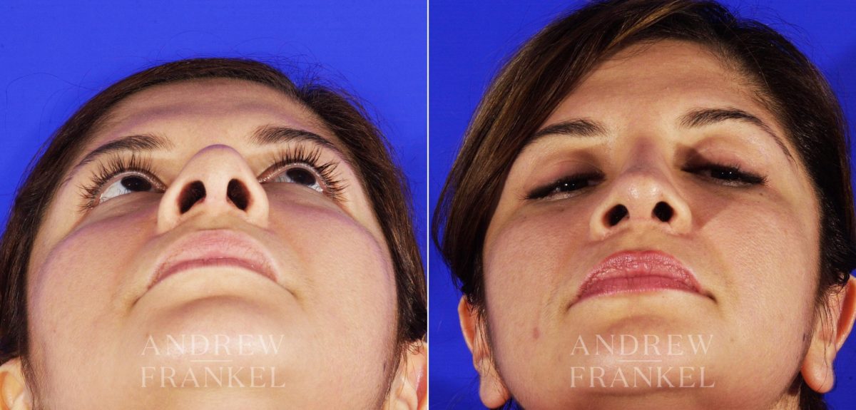 Revision Rhinoplasty before and after photos in Beverly Hills, CA, Patient 4454