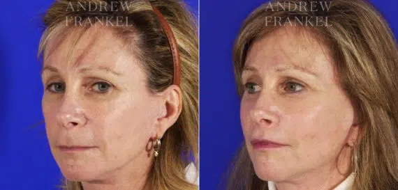 Lip Lift before and after photos in Beverly Hills, CA, Patient 4466