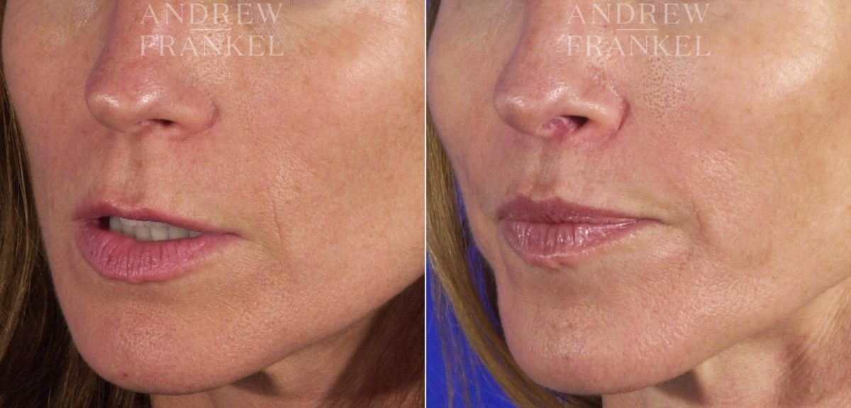 Lip Lift before and after photos in Beverly Hills, CA, Patient 4483