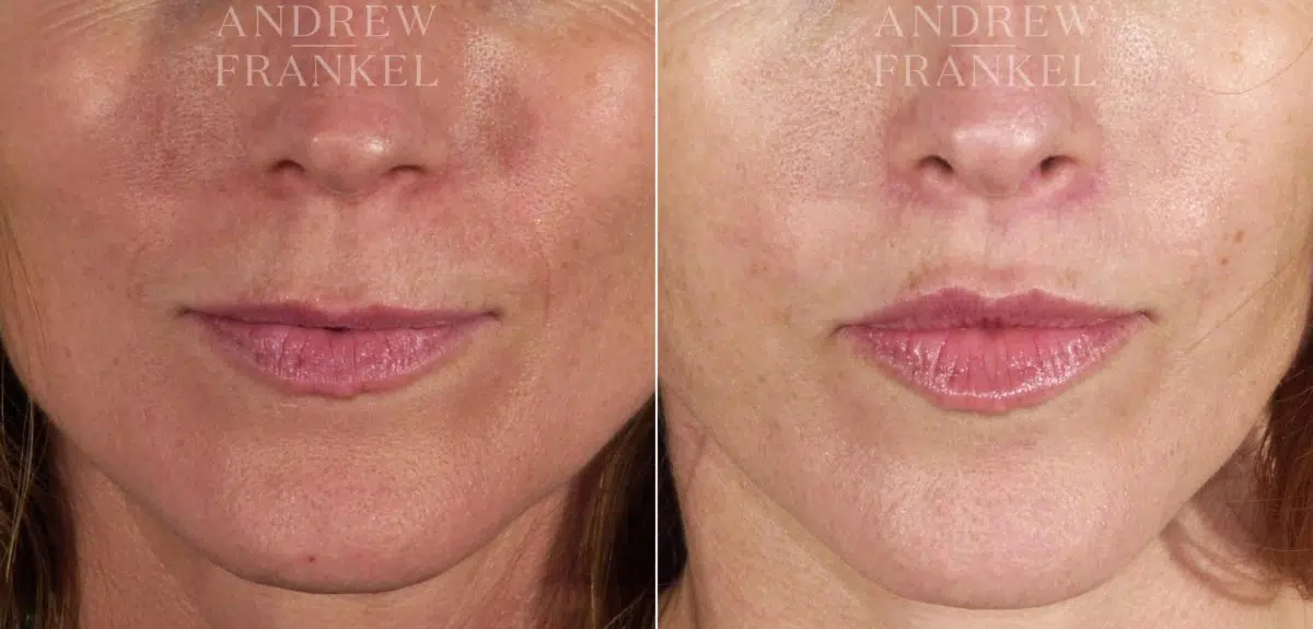 Lip Lift before and after photos in Beverly Hills, CA, Patient 4483