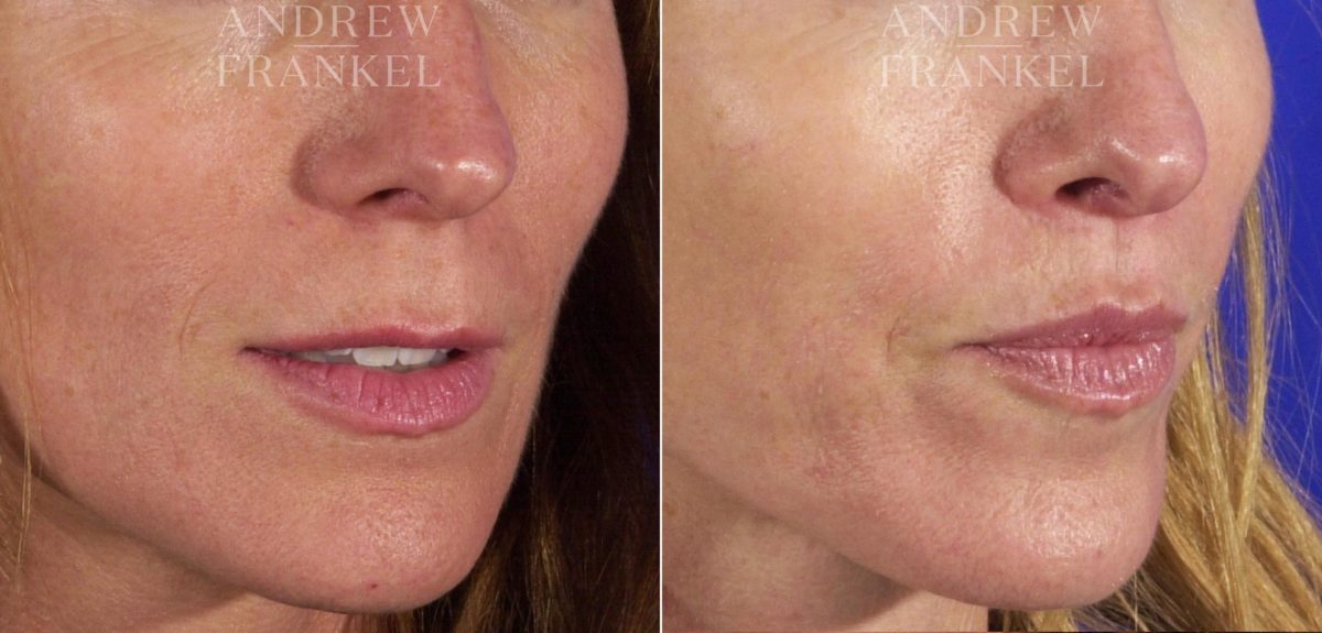 Lip Lift before and after photos in Beverly Hills, CA, Patient 4483