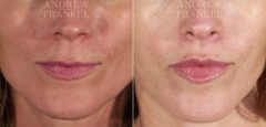 Lip Lift before and after photos in Beverly Hills, CA, Patient 4483