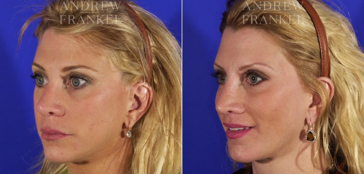 Lip Lift before and after photos in Beverly Hills, CA, Patient 4506