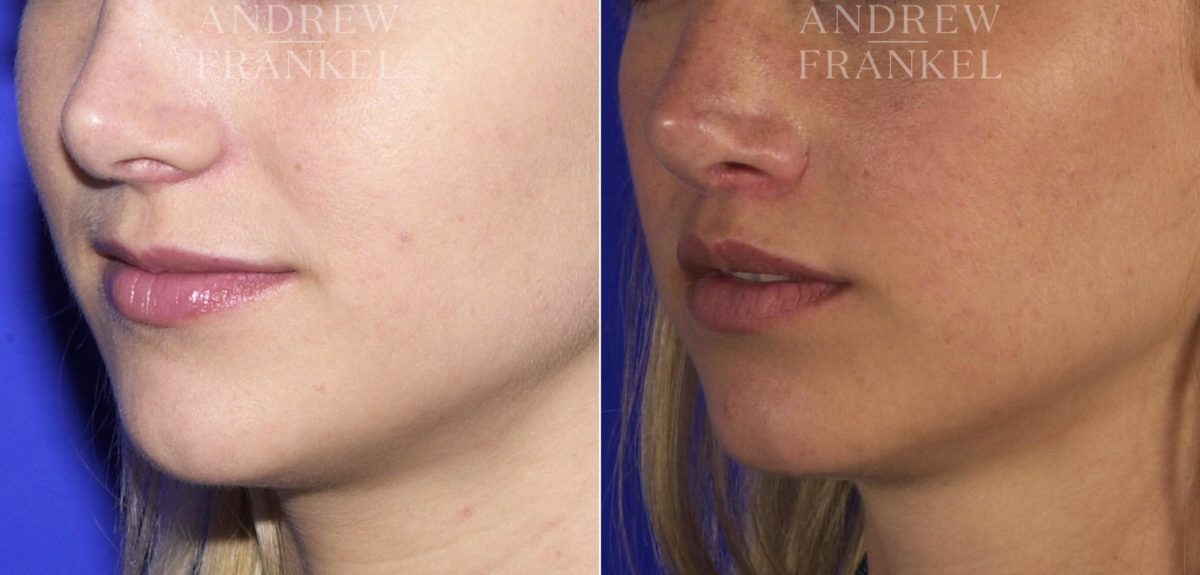 Lip Lift before and after photos in Beverly Hills, CA, Patient 4536