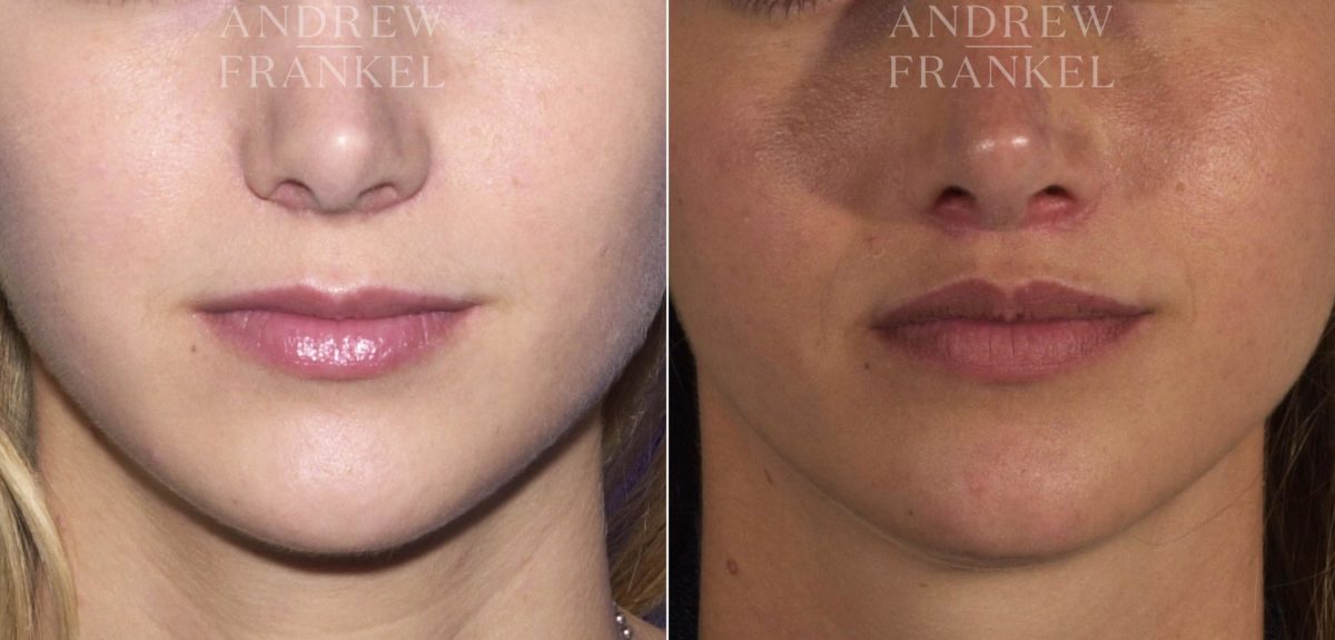 Lip Lift before and after photos in Beverly Hills, CA, Patient 4536