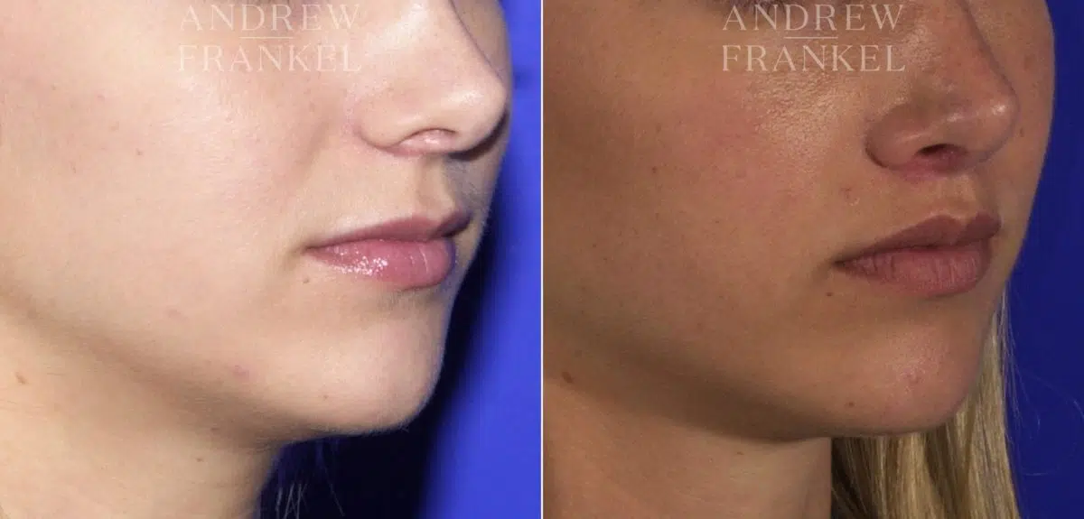 Lip Lift before and after photos in Beverly Hills, CA, Patient 4536