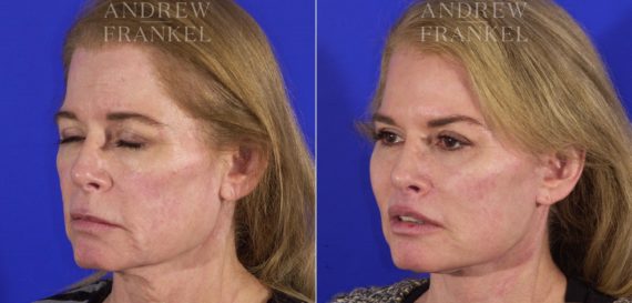 Lip Lift before and after photos in Beverly Hills, CA, Patient 4562