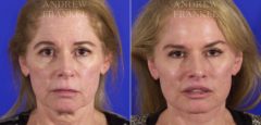 Lip Lift before and after photos in Beverly Hills, CA, Patient 4562