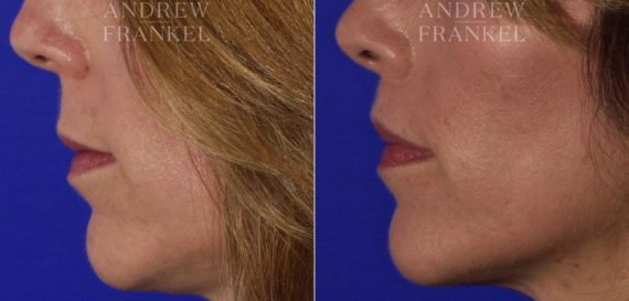 Lip Lift before and after photos in Beverly Hills, CA, Patient 4575